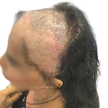 protese-capilar-feminina