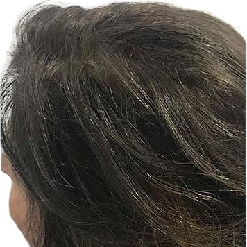 protese-capilar-feminina