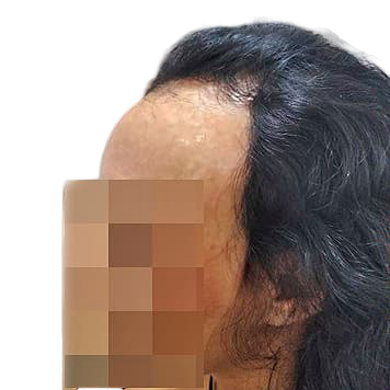 protese-capilar-feminina