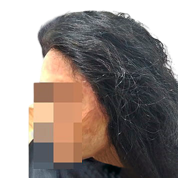 protese-capilar-feminina