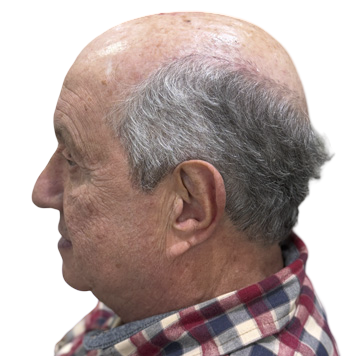 protese-capilar-masculina