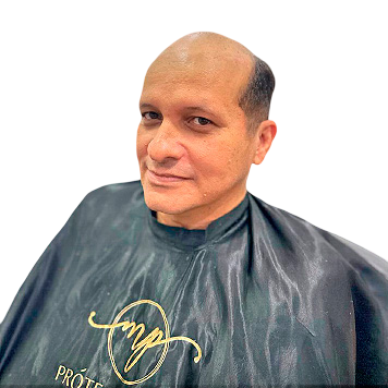 protese-capilar-masculino