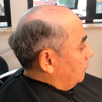 protese-capilar-masculino