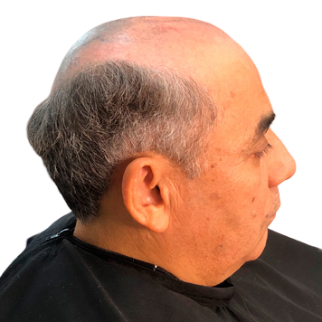 protese-capilar-masculino