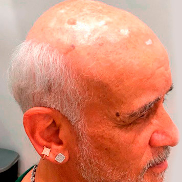 protese-capilar-masculino