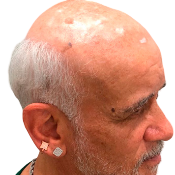 protese-capilar-masculino