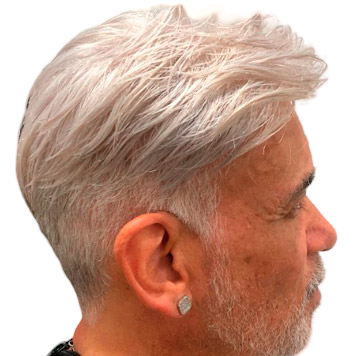 protese-capilar-masculino